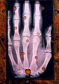 Hand X-Ray 1